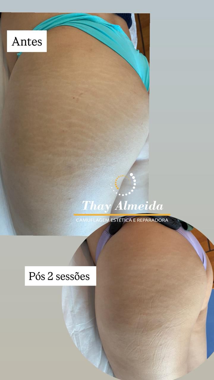 Resultado camuflagem paramédica